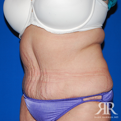 Tummy Tuck