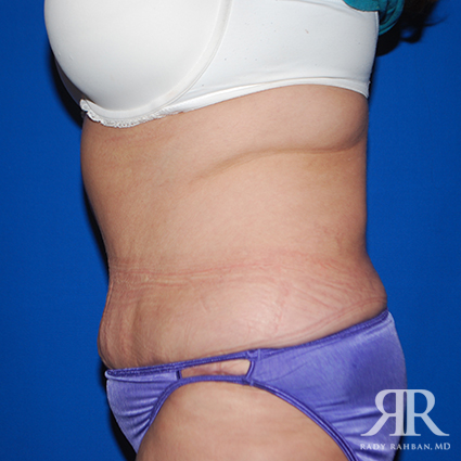 Tummy Tuck