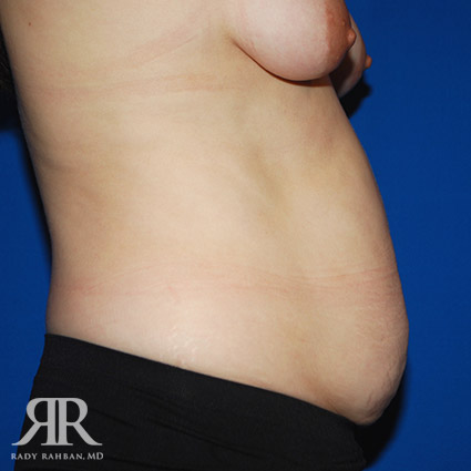 Tummy Tuck