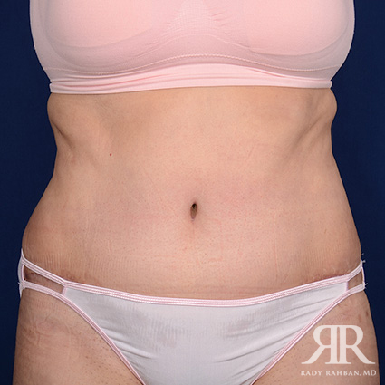 Tummy Tuck