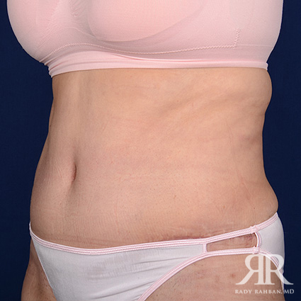 Tummy Tuck