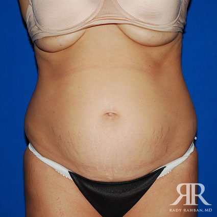 Tummy Tuck