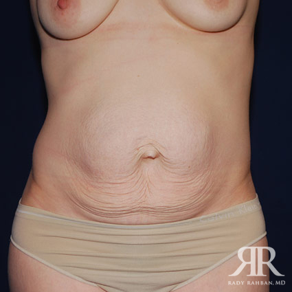 Tummy Tuck