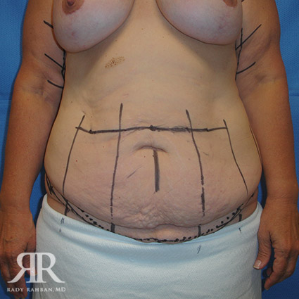 Tummy Tuck