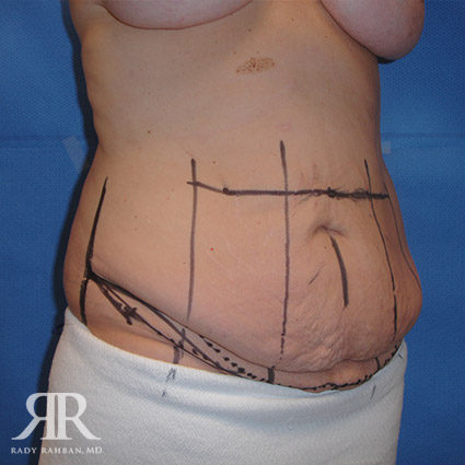 Tummy Tuck