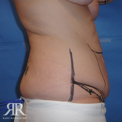 Tummy Tuck