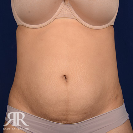 Tummy Tuck