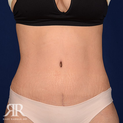 Tummy Tuck