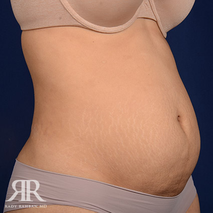 Tummy Tuck