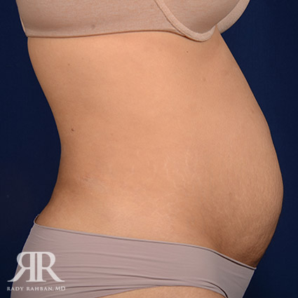 Tummy Tuck