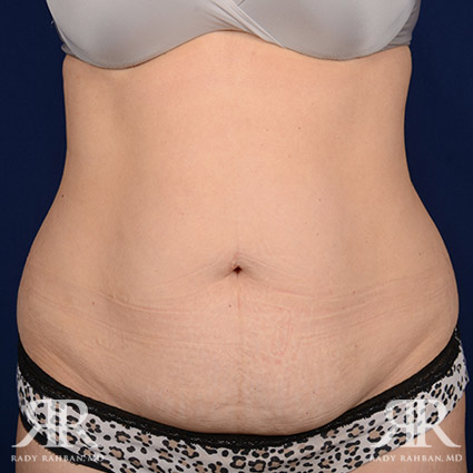 Tummy Tuck