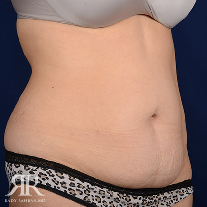 Tummy Tuck