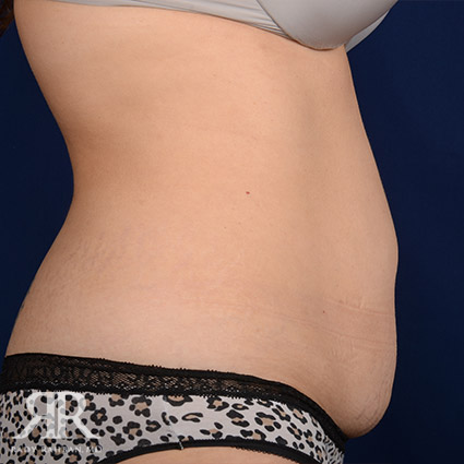 Tummy Tuck