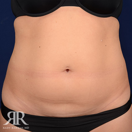 Tummy Tuck