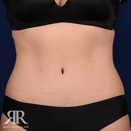 Tummy Tuck