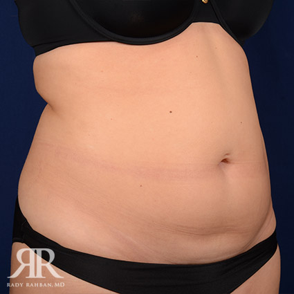 Tummy Tuck