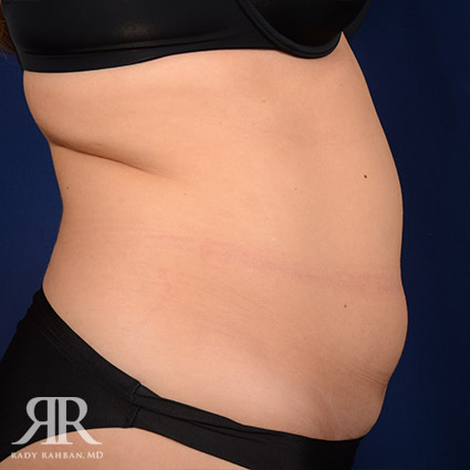 Tummy Tuck