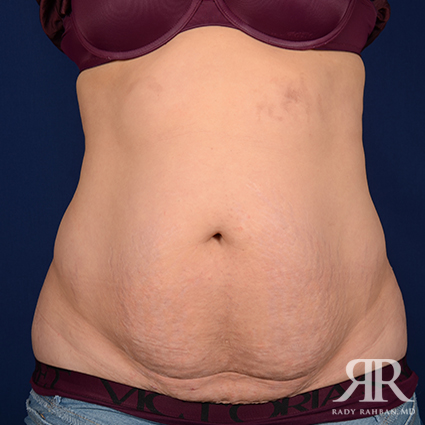 Tummy Tuck