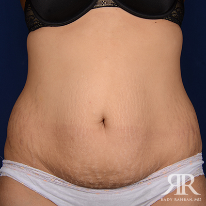 Tummy Tuck