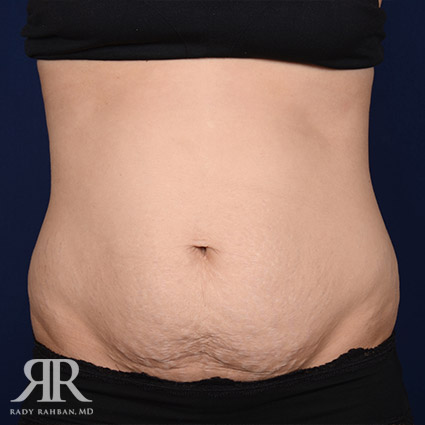 Tummy Tuck