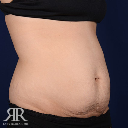 Tummy Tuck