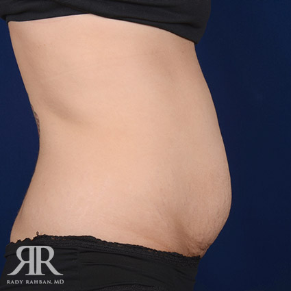 Tummy Tuck