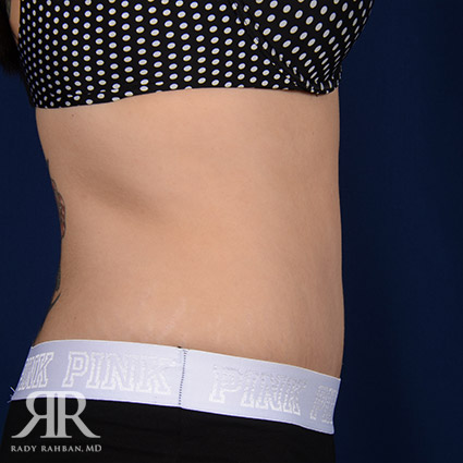 Tummy Tuck