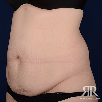 Tummy Tuck