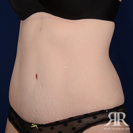 Tummy Tuck