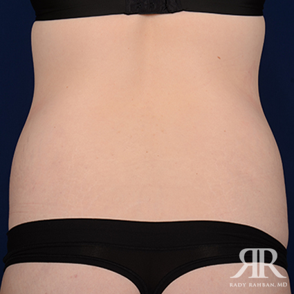 Tummy Tuck