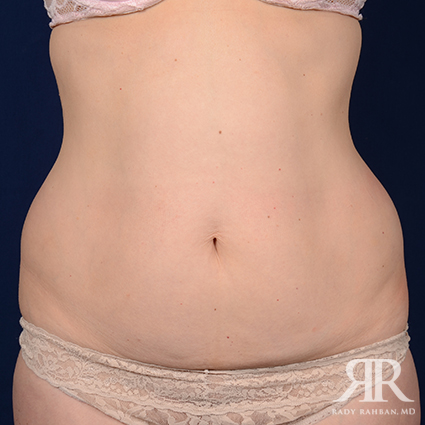 Tummy Tuck