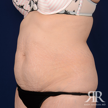 Tummy Tuck