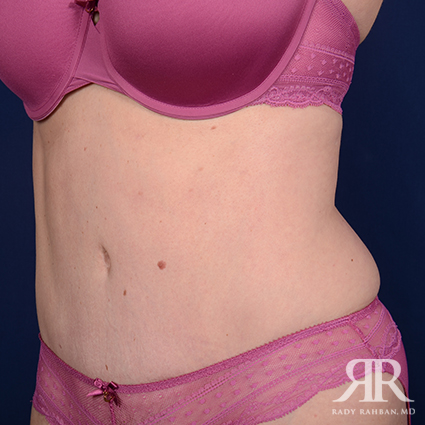 Tummy Tuck