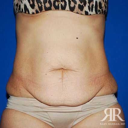 Tummy Tuck