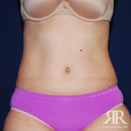 Tummy Tuck