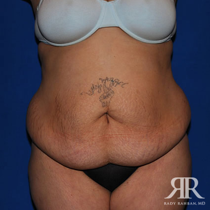 Tummy Tuck