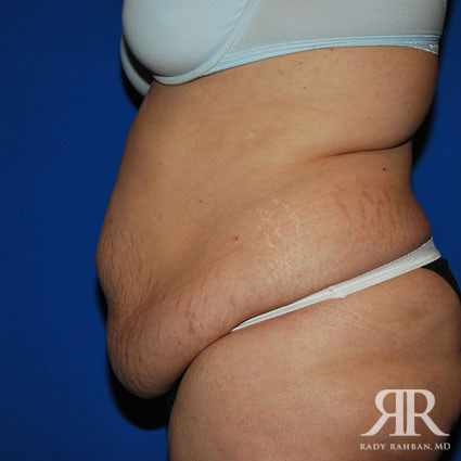 Tummy Tuck