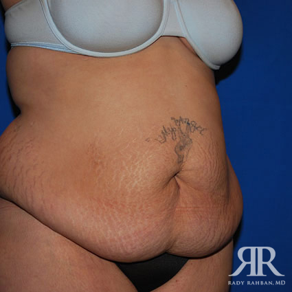 Tummy Tuck