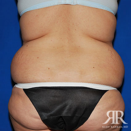 Tummy Tuck