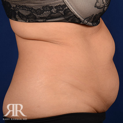 Tummy Tuck