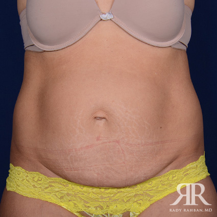 Tummy Tuck