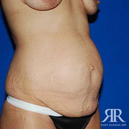 Tummy Tuck