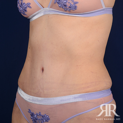 Tummy Tuck