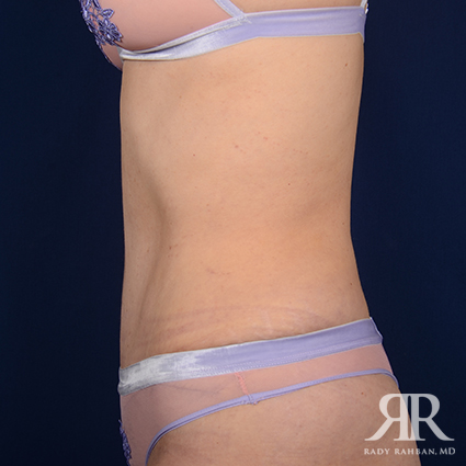 Tummy Tuck