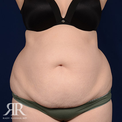 Tummy Tuck