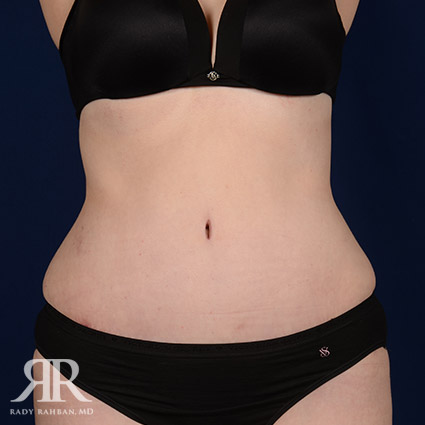 Tummy Tuck