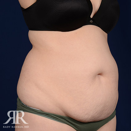 Tummy Tuck