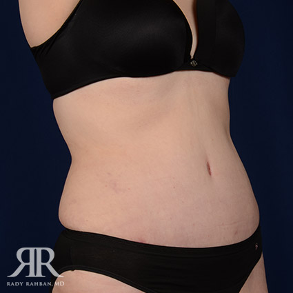 Tummy Tuck