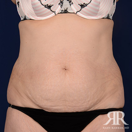 Tummy Tuck