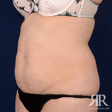 Tummy Tuck